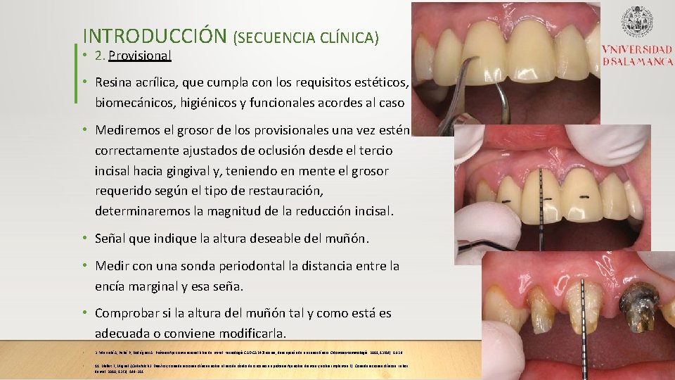 INTRODUCCIÓN (SECUENCIA CLÍNICA) • 2. Provisional • Resina acrílica, que cumpla con los requisitos