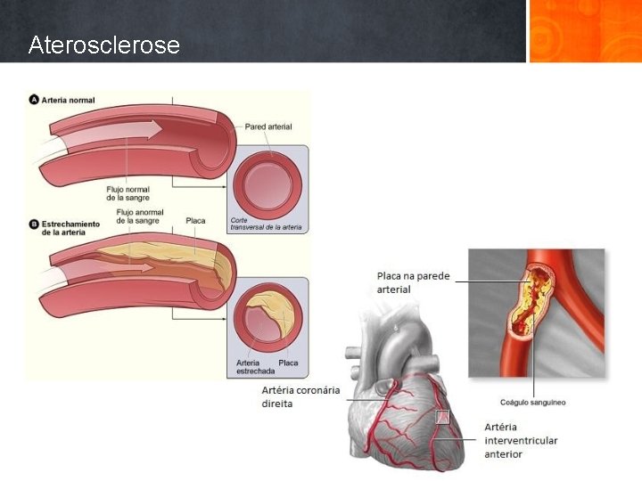 Aterosclerose 