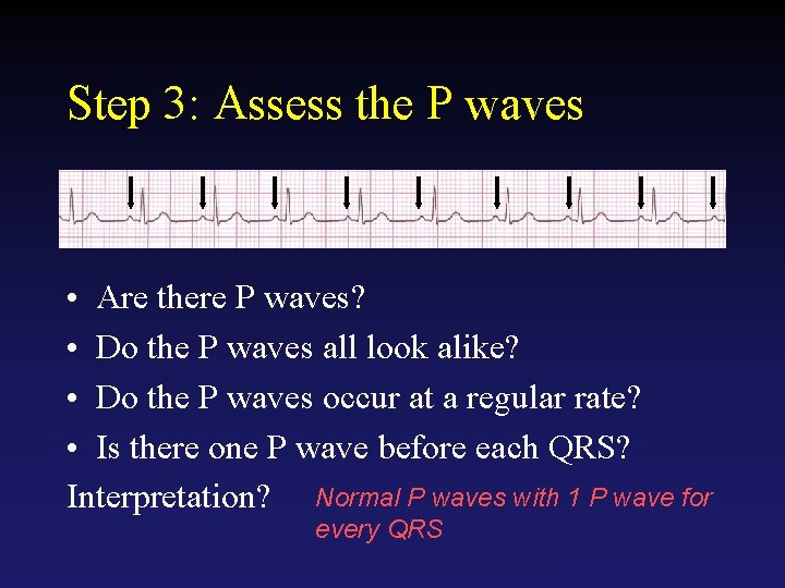 Step 3: Assess the P waves • Are there P waves? • Do the