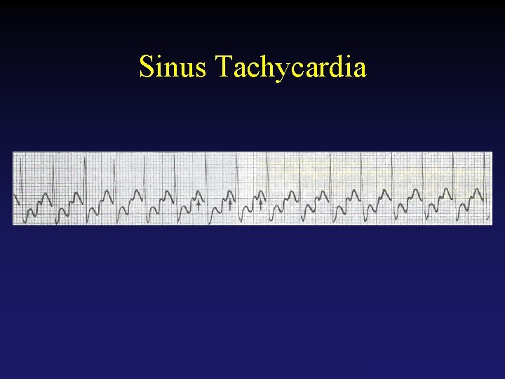 Sinus Tachycardia Tehran Arrhythmia Center 