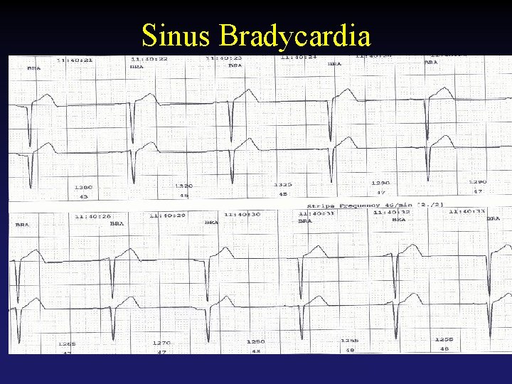 Sinus Bradycardia Tehran Arrhythmia Center 