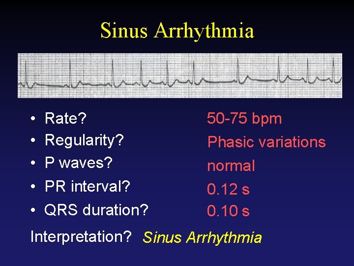 Sinus Arrhythmia • • • Rate? Regularity? P waves? PR interval? QRS duration? 50