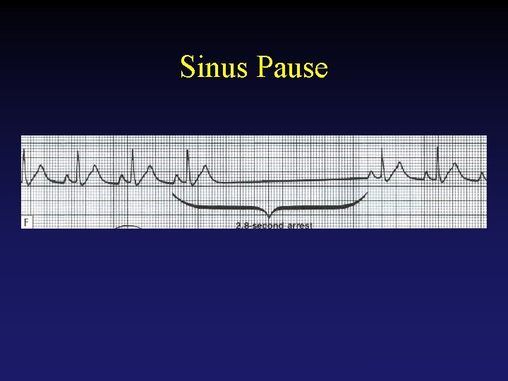 Sinus Pause Tehran Arrhythmia Center 