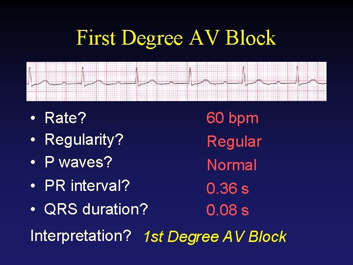 First Degree AV Block • • • Rate? Regularity? P waves? PR interval? QRS