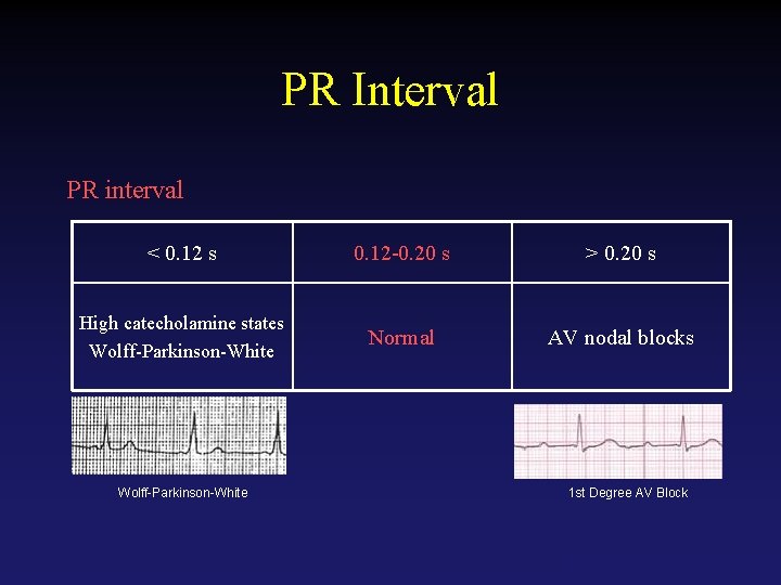 PR Interval PR interval < 0. 12 s 0. 12 -0. 20 s >