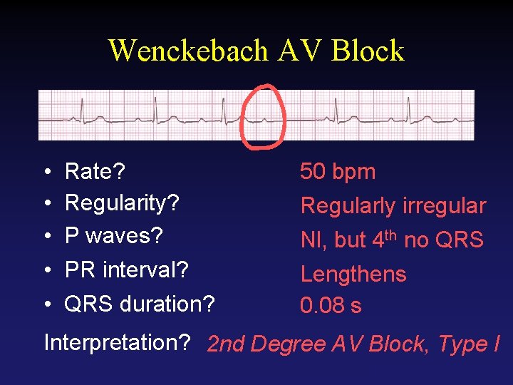 Wenckebach AV Block • • • Rate? Regularity? P waves? PR interval? QRS duration?