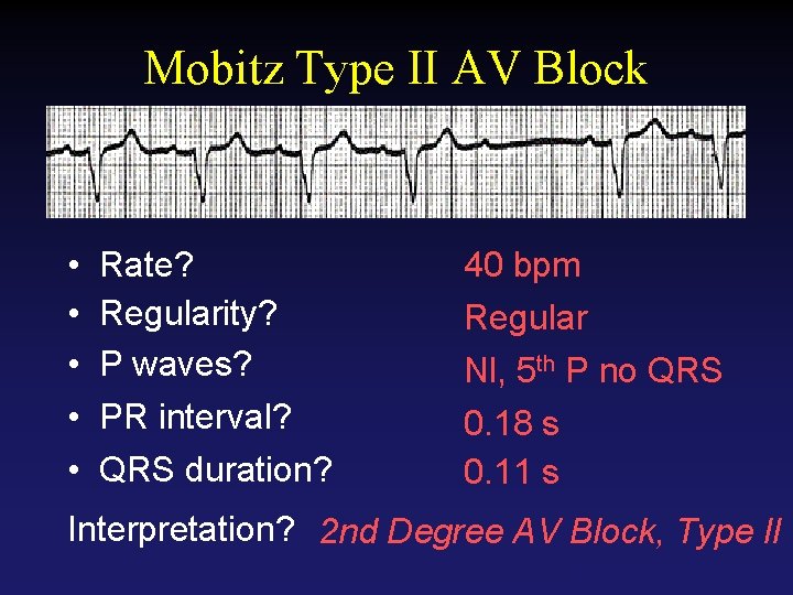 Mobitz Type II AV Block • • • Rate? Regularity? P waves? PR interval?