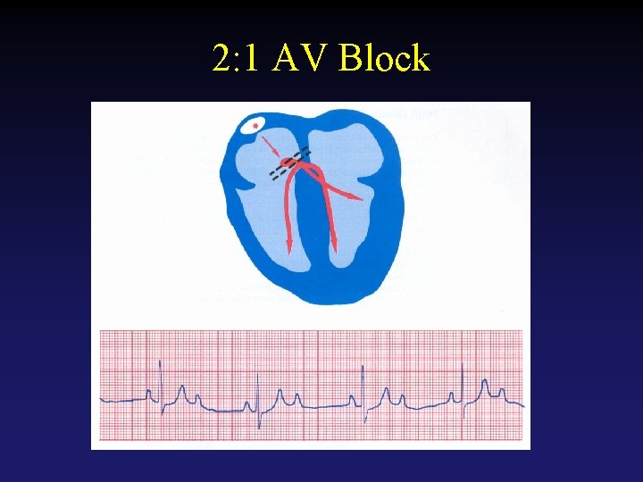 2: 1 AV Block Tehran Arrhythmia Center 