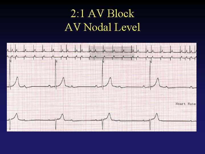 2: 1 AV Block AV Nodal Level Tehran Arrhythmia Center 