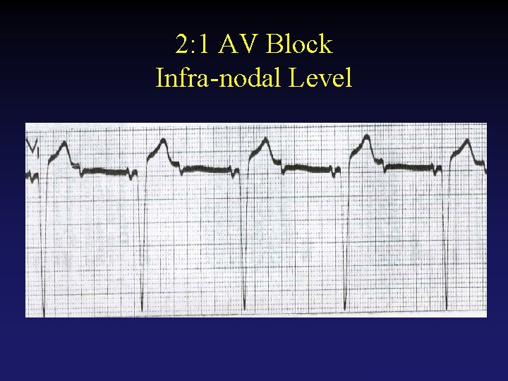 2: 1 AV Block Infra-nodal Level Tehran Arrhythmia Center 