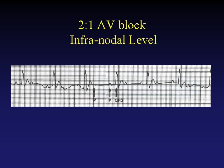 2: 1 AV block Infra-nodal Level Tehran Arrhythmia Center 