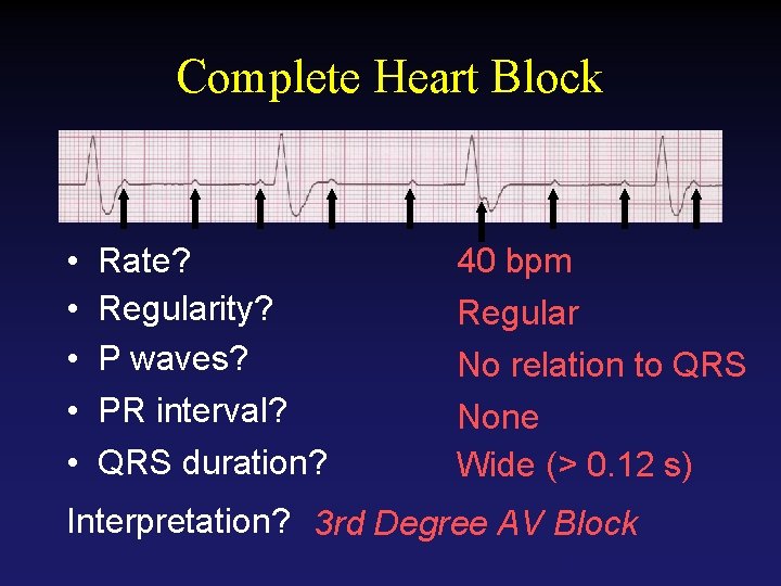 Complete Heart Block • • • Rate? Regularity? P waves? PR interval? QRS duration?