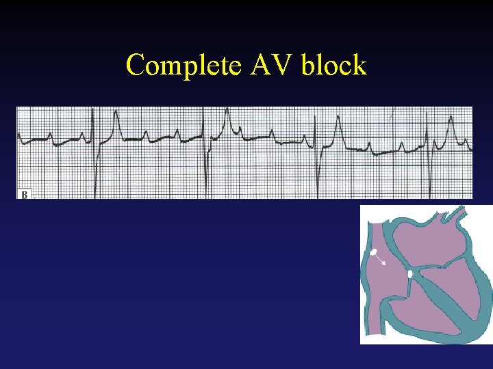 Complete AV block Tehran Arrhythmia Center 