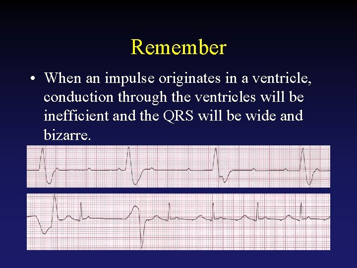 Remember • When an impulse originates in a ventricle, conduction through the ventricles will