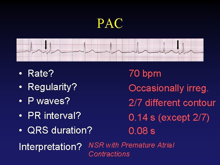 PAC • • • Rate? Regularity? P waves? PR interval? QRS duration? Interpretation? 70
