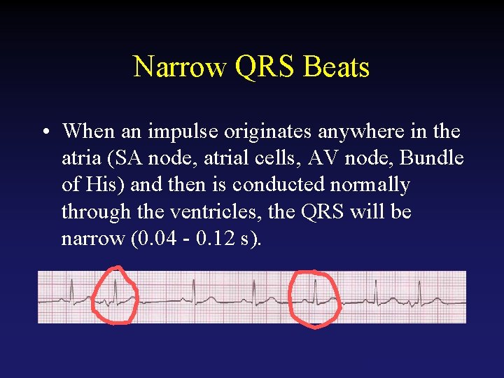 Narrow QRS Beats • When an impulse originates anywhere in the atria (SA node,