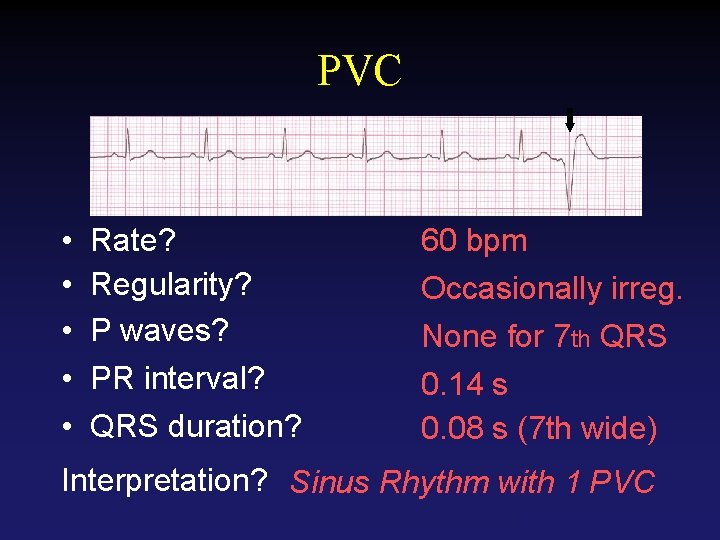 PVC • • • Rate? Regularity? P waves? PR interval? QRS duration? 60 bpm