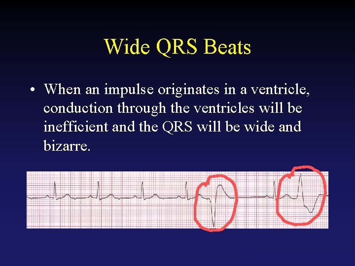 Wide QRS Beats • When an impulse originates in a ventricle, conduction through the