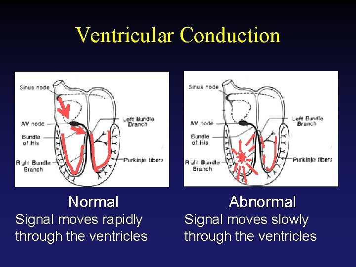 Ventricular Conduction Normal Signal moves rapidly through the ventricles Abnormal Signal moves slowly through