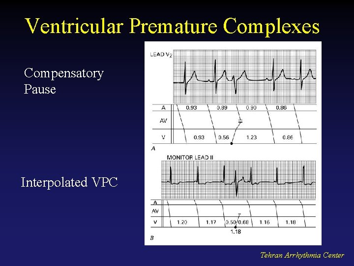 Ventricular Premature Complexes Compensatory Pause Interpolated VPC Tehran Arrhythmia Center 