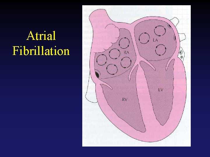 Atrial Fibrillation Tehran Arrhythmia Center 