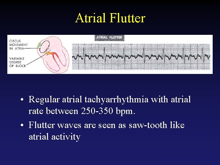 Atrial Flutter • Regular atrial tachyarrhythmia with atrial rate between 250 -350 bpm. •