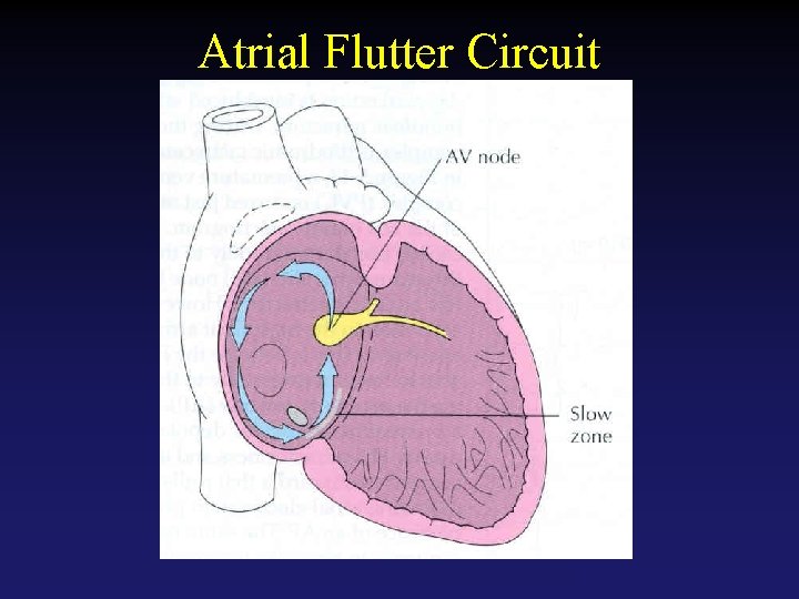 Atrial Flutter Circuit Tehran Arrhythmia Center 