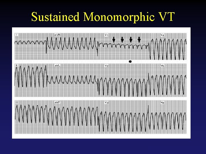 Sustained Monomorphic VT Tehran Arrhythmia Center 