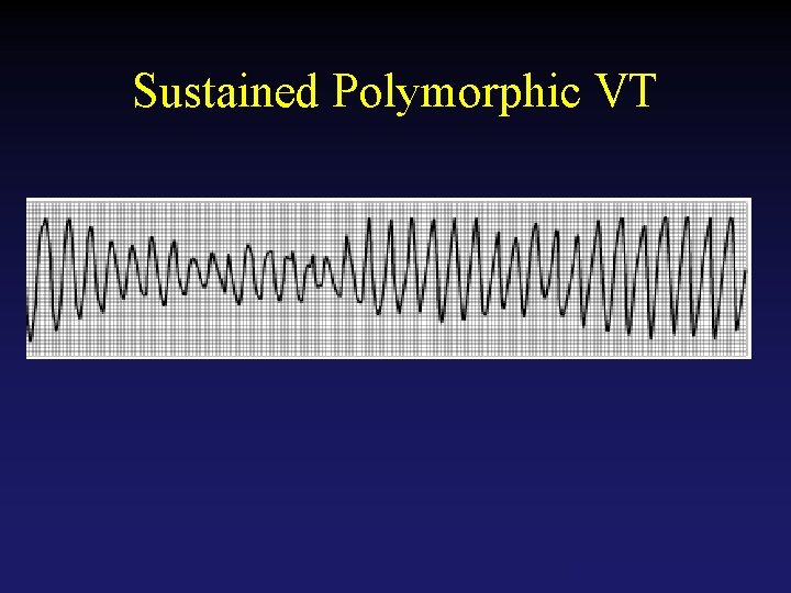 Sustained Polymorphic VT Tehran Arrhythmia Center 