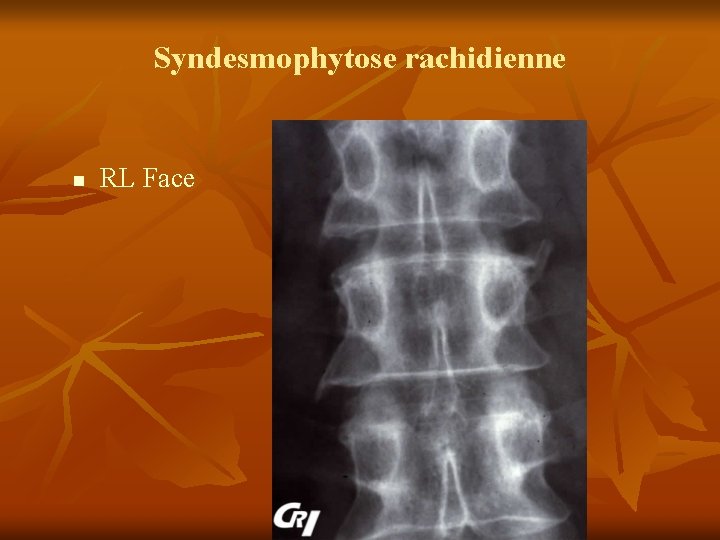 Profil Compatible Avec Un Syndrome Inflammatoire Modéré