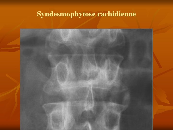 Syndesmophytose rachidienne 