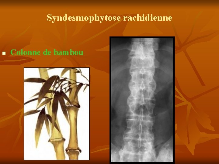 Syndesmophytose rachidienne n Colonne de bambou 