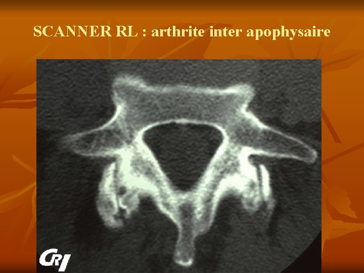 SCANNER RL : arthrite inter apophysaire 