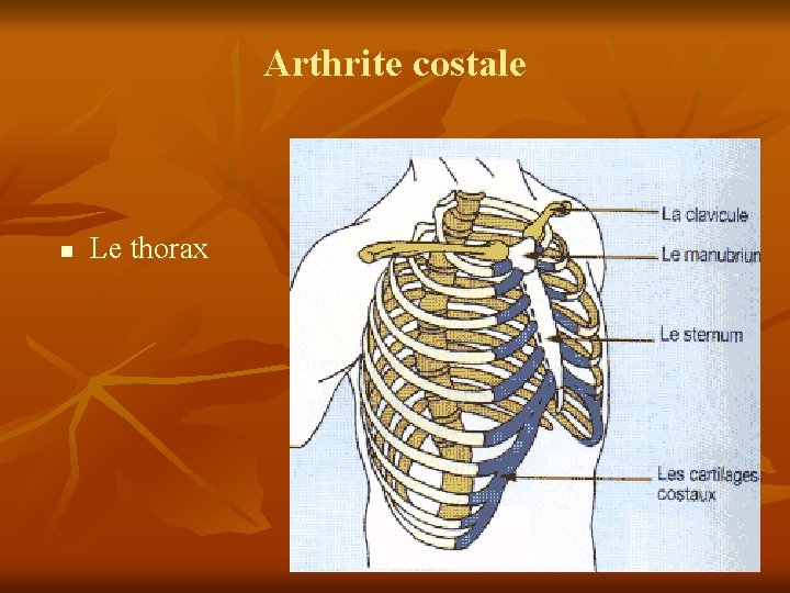 Arthrite costale n Le thorax 