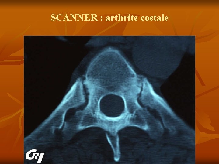 SCANNER : arthrite costale 