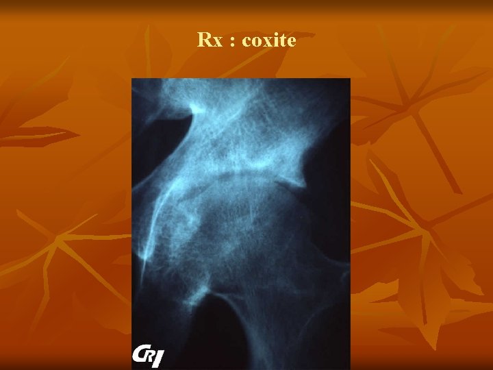 Rx : coxite 