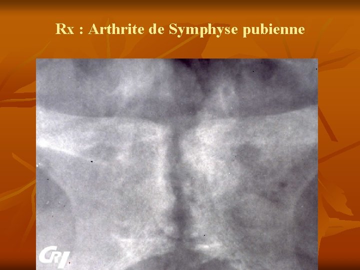 Rx : Arthrite de Symphyse pubienne 