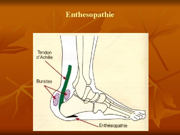 Enthesopathie 