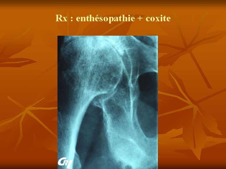 Rx : enthésopathie + coxite 