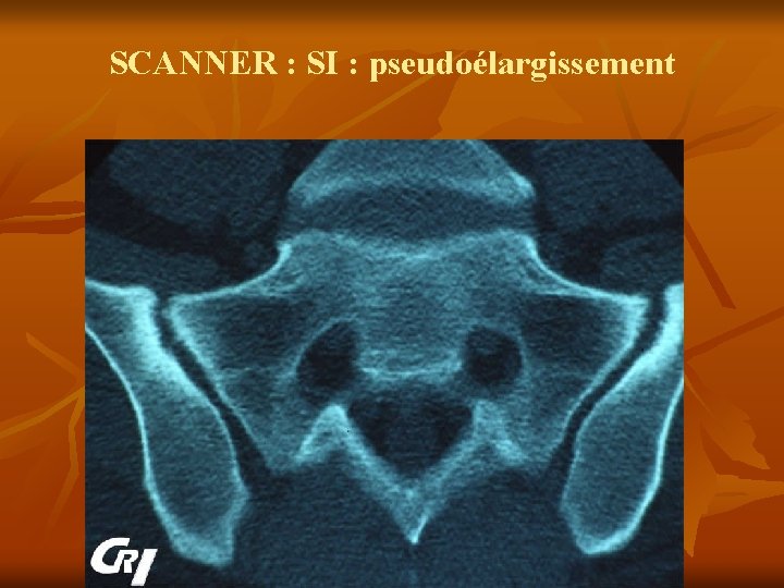 SCANNER : SI : pseudoélargissement 