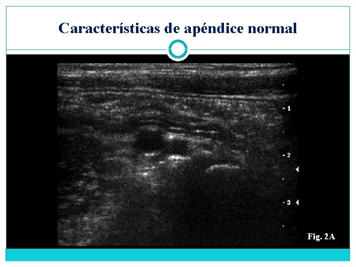 Características de apéndice normal Fig. 2 A 