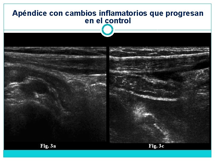 Apéndice con cambios inflamatorios que progresan en el control Fig. 3 a Fig. 3