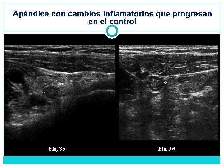 Apéndice con cambios inflamatorios que progresan en el control Fig. 3 b Fig. 3