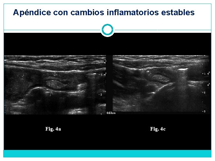 Apéndice con cambios inflamatorios estables Fig. 4 a Fig. 4 c 