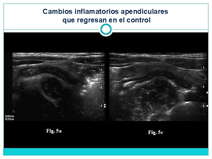 Cambios inflamatorios apendiculares que regresan en el control Fig. 5 a Fig. 5 c