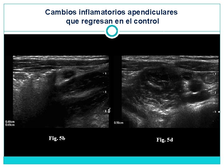 Cambios inflamatorios apendiculares que regresan en el control Fig. 5 b Fig. 5 d