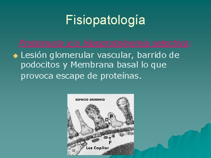 Fisiopatología Proteinuria y/o hipoproteinemia selectiva: u Lesión glomerular vascular, barrido de podocitos y Membrana