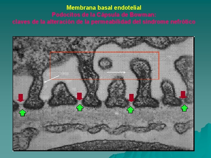 Membrana basal endotelial Podocitos de la Cápsula de Bowman: claves de la alteración de