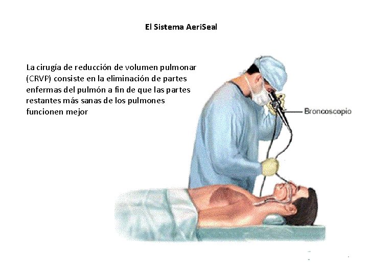 El Sistema Aeri. Seal La cirugía de reducción de volumen pulmonar (CRVP) consiste en