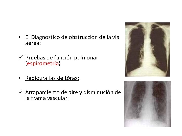  • El Diagnostico de obstrucción de la vía aérea: ü Pruebas de función